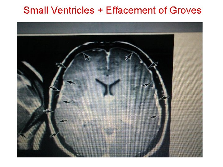 Small Ventricles + Effacement of Groves Small Ventricles + Effacement of Groves