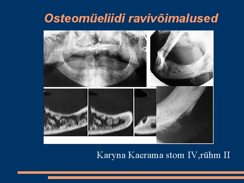 Osteomüeliidi ravivõimalused Karyna Kaerama stom IV, rühm II 