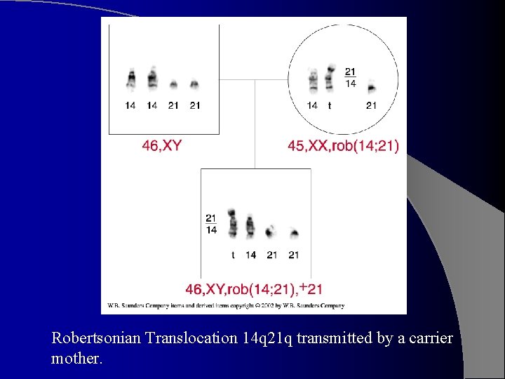 Robertsonian Translocation 14 q 21 q transmitted by a carrier mother. 