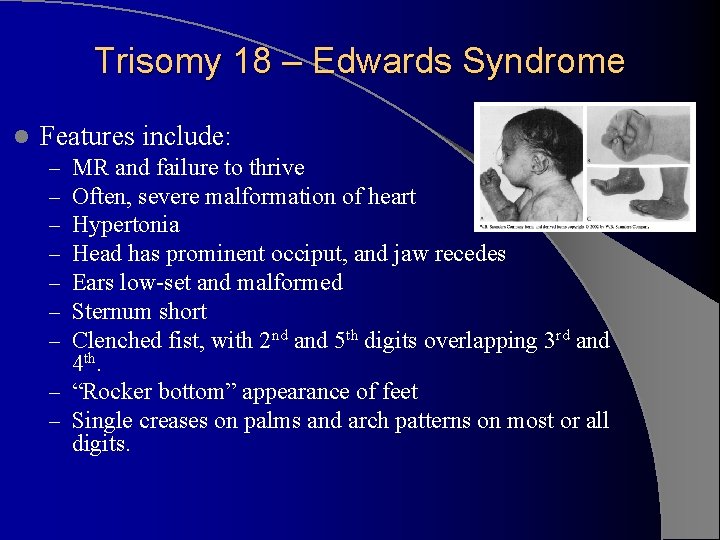 Trisomy 18 – Edwards Syndrome l Features include: MR and failure to thrive Often,