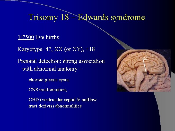 Trisomy 18 – Edwards syndrome 1/7500 live births Karyotype: 47, XX (or XY), +18
