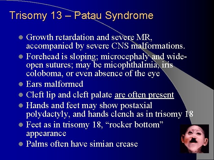 Trisomy 13 – Patau Syndrome Growth retardation and severe MR, accompanied by severe CNS