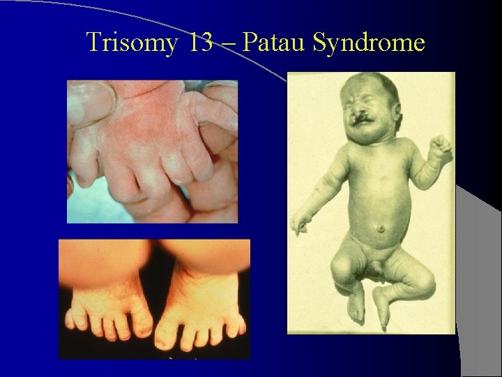Trisomy 13 – Patau Syndrome 
