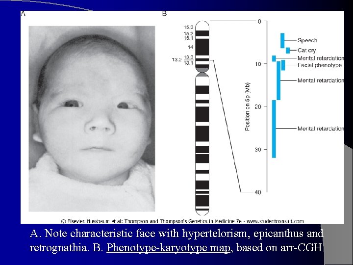 A. Note characteristic face with hypertelorism, epicanthus and retrognathia. B. Phenotype-karyotype map, based on