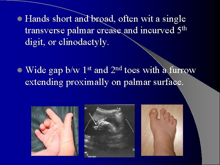 l Hands short and broad, often wit a single transverse palmar crease and incurved