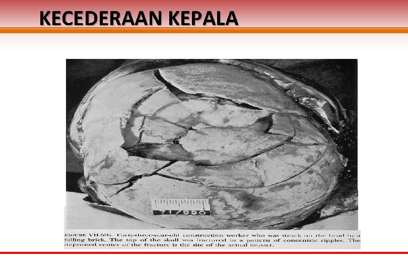 KECEDERAAN KEPALA KECEDERAAN KEPALA