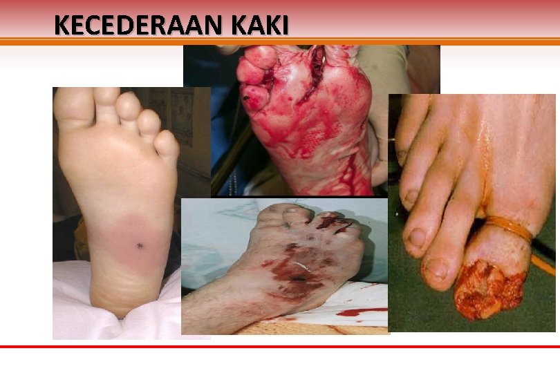 KECEDERAAN KAKI 