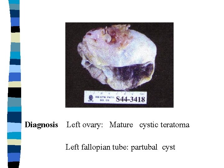 Diagnosis Left ovary: Mature cystic teratoma Left fallopian tube: partubal cyst 