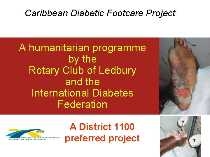 Caribbean Diabetic Footcare Project A humanitarian programme by the Rotary Club of Ledbury and