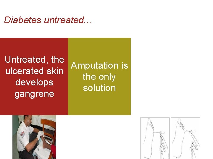 Diabetes untreated. . . Untreated, the Amputation is ulcerated skin the only develops solution