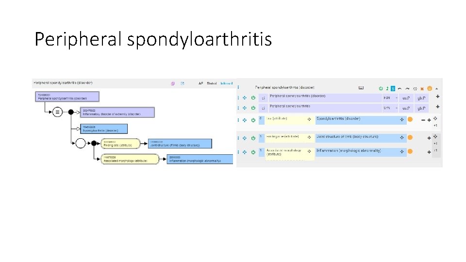 Peripheral spondyloarthritis 