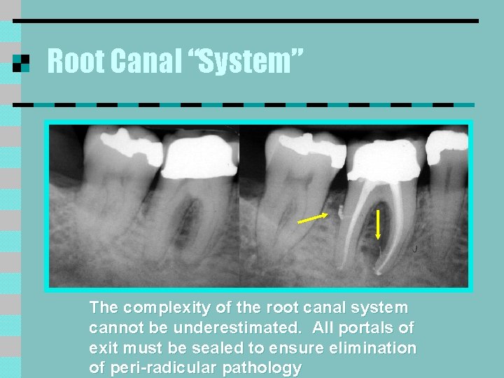 Root Canal “System” The complexity of the root canal system cannot be underestimated. All Root Canal “System” The complexity of the root canal system cannot be underestimated. All