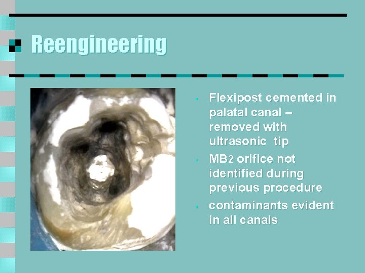 Reengineering § § § Flexipost cemented in palatal canal – removed with ultrasonic tip Reengineering § § § Flexipost cemented in palatal canal – removed with ultrasonic tip