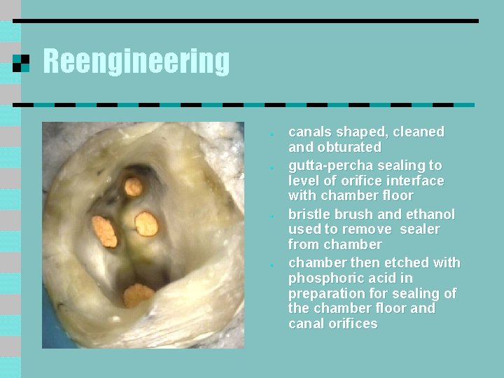 Reengineering § § canals shaped, cleaned and obturated gutta-percha sealing to level of orifice Reengineering § § canals shaped, cleaned and obturated gutta-percha sealing to level of orifice