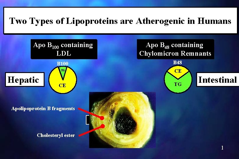 Two Types of Lipoproteins are Atherogenic in Humans Apo B 100 containing LDL Hepatic