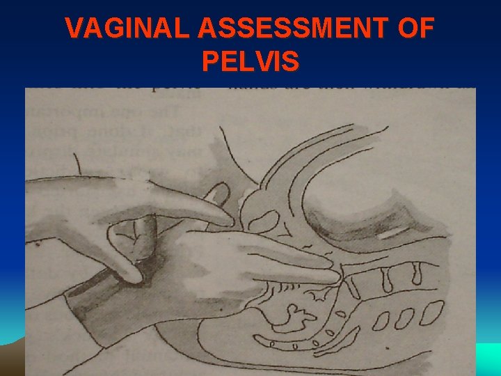 VAGINAL ASSESSMENT OF PELVIS 