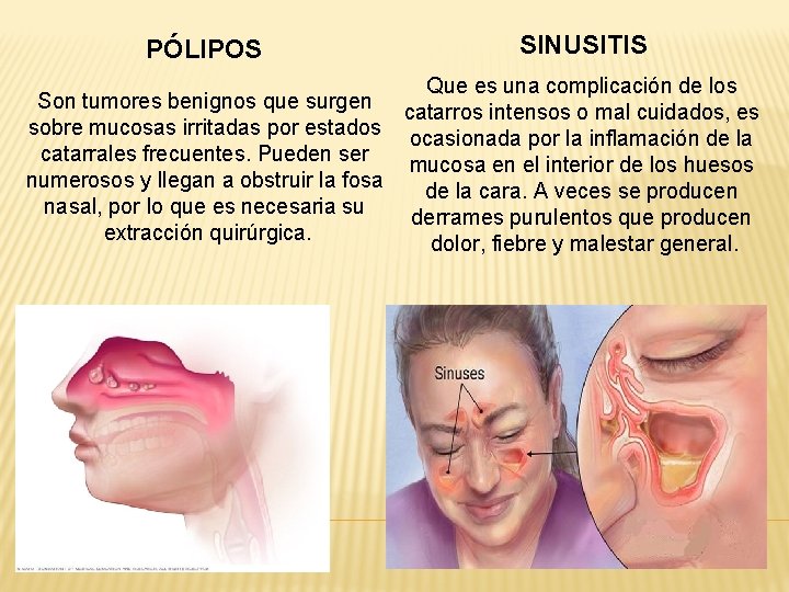  PÓLIPOS Son tumores benignos que surgen sobre mucosas irritadas por estados catarrales frecuentes.