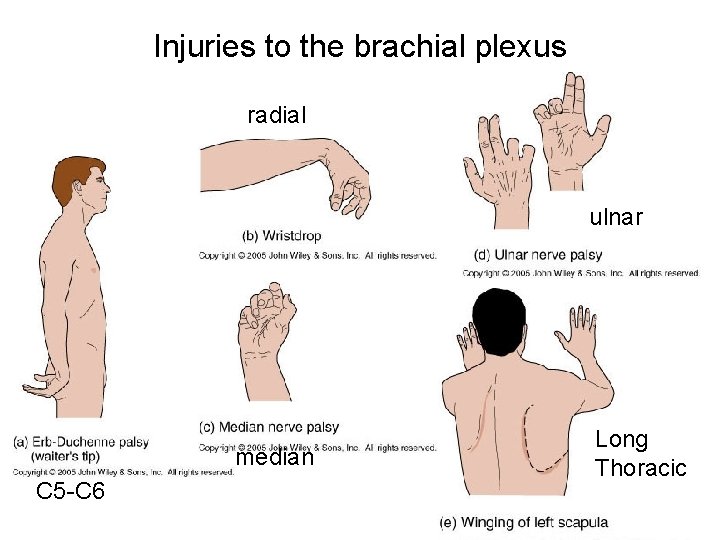 Injuries to the brachial plexus radial ulnar median C 5 -C 6 Long Thoracic