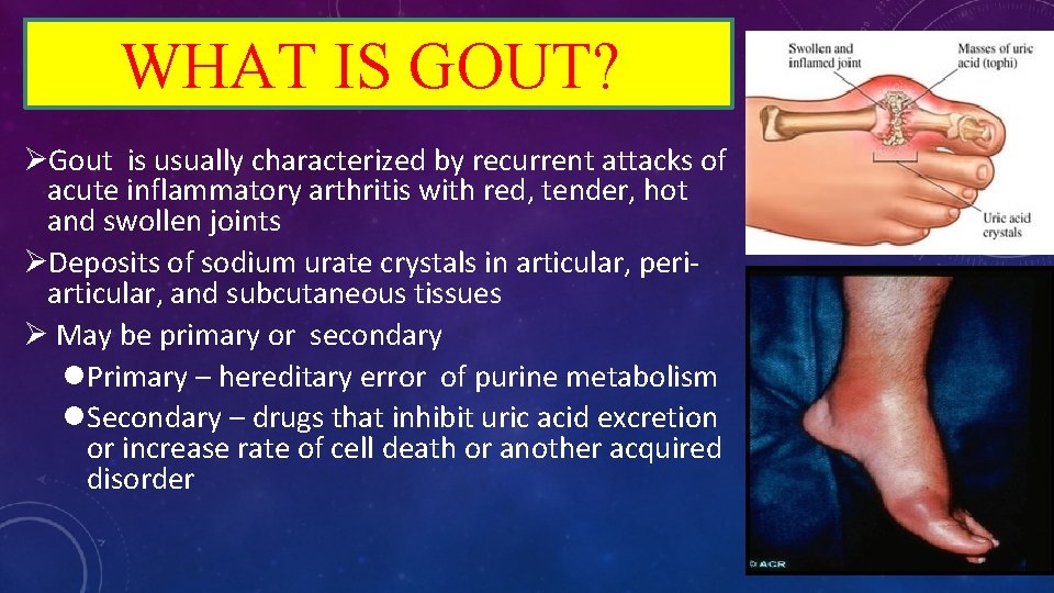 WHAT IS GOUT? ØGout is usually characterized by recurrent attacks of acute inflammatory arthritis