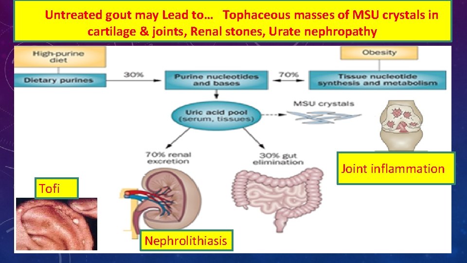 Untreated gout may Lead to… Tophaceous masses of MSU crystals in cartilage & joints,