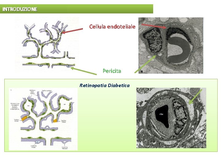 INTRODUZIONE Cellula endoteliale Pericita Retinopatia Diabetica 