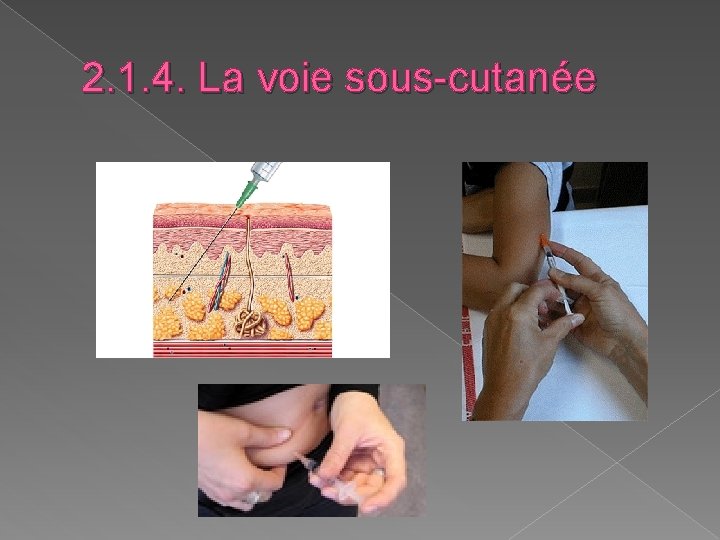 2. 1. 4. La voie sous-cutanée 2. 1. 4. La voie sous-cutanée