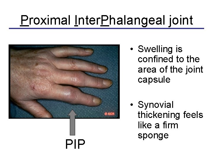 Proximal Inter. Phalangeal joint • Swelling is confined to the area of the joint