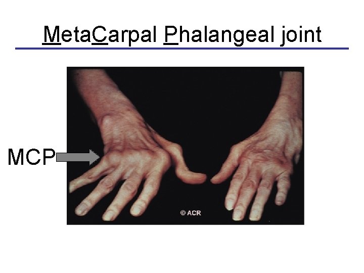 Meta. Carpal Phalangeal joint MCP 