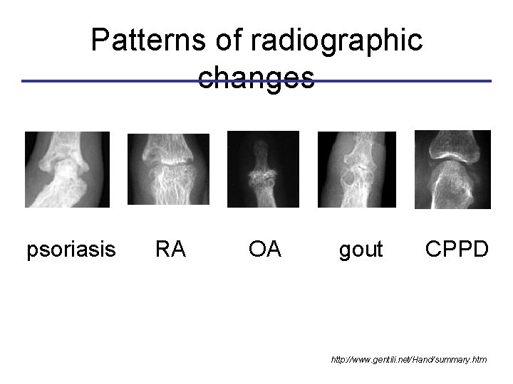 Patterns of radiographic changes psoriasis RA OA gout CPPD http: //www. gentili. net/Hand/summary. htm