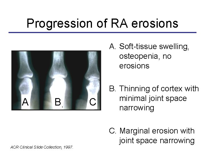 Progression of RA erosions How fast is joint damage progressing? A. Soft-tissue swelling, osteopenia,
