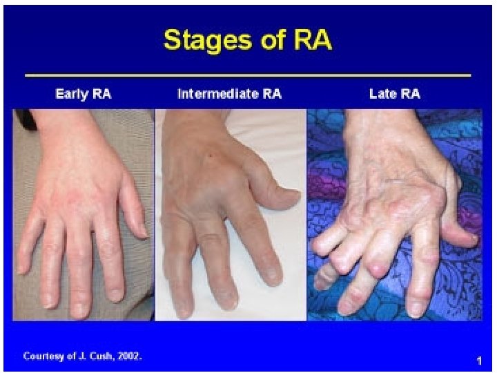 rheumatoid arthritis hogyan kezelik