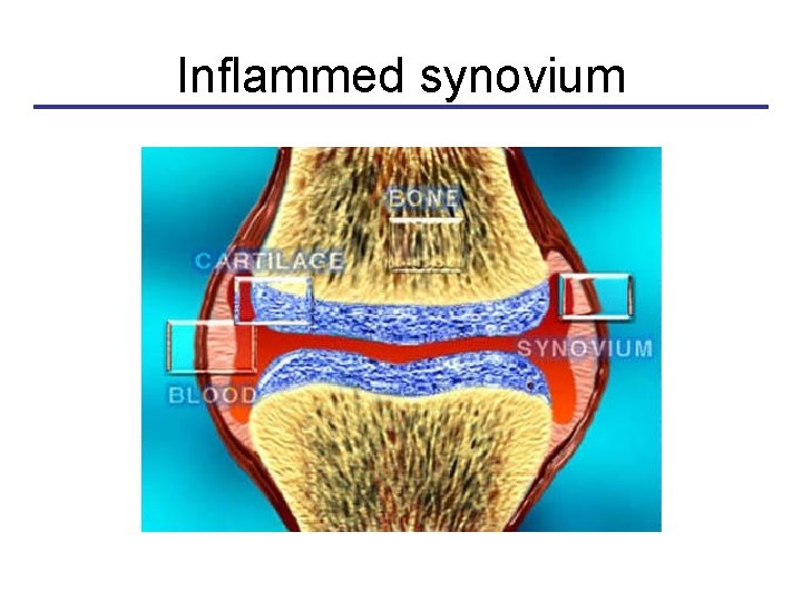 Inflammed synovium 