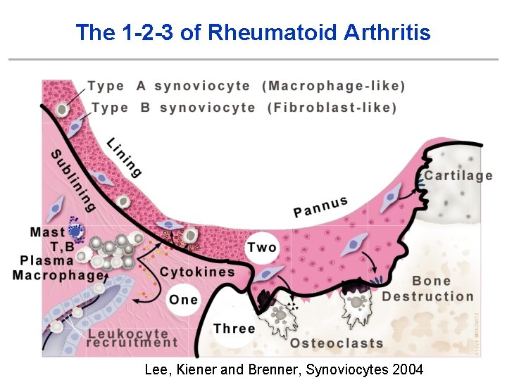 The 1 -2 -3 of Rheumatoid Arthritis Lee, Kiener and Brenner, Synoviocytes 2004 