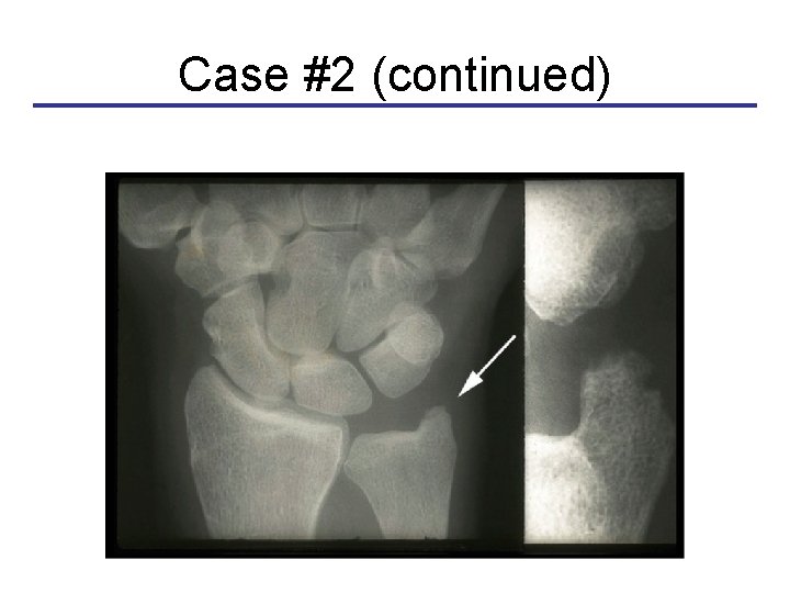 Case #2 (continued) Early erosion at the tip of the ulnar styloid 