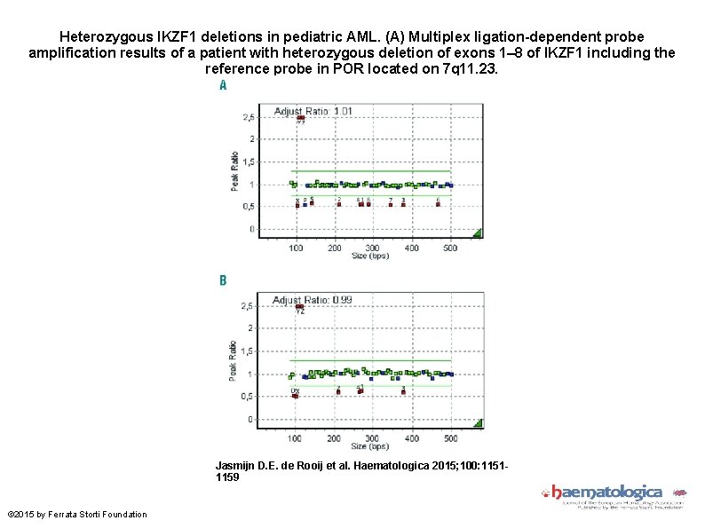 Heterozygous IKZF 1 deletions in pediatric AML. (A) Multiplex ligation-dependent probe amplification results of Heterozygous IKZF 1 deletions in pediatric AML. (A) Multiplex ligation-dependent probe amplification results of