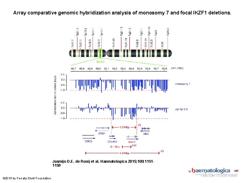 Array comparative genomic hybridization analysis of monosomy 7 and focal IKZF 1 deletions. Jasmijn Array comparative genomic hybridization analysis of monosomy 7 and focal IKZF 1 deletions. Jasmijn