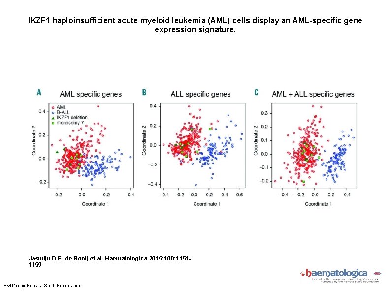 IKZF 1 haploinsufficient acute myeloid leukemia (AML) cells display an AML-specific gene expression signature. IKZF 1 haploinsufficient acute myeloid leukemia (AML) cells display an AML-specific gene expression signature.