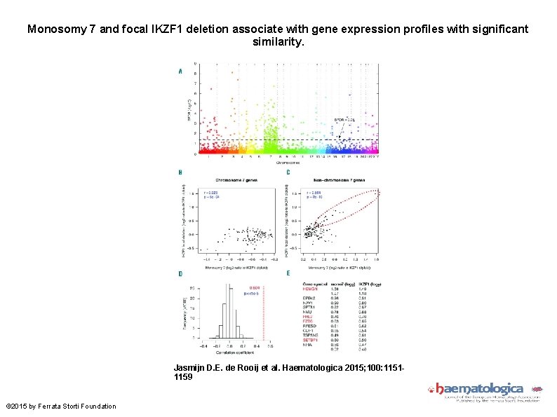 Monosomy 7 and focal IKZF 1 deletion associate with gene expression profiles with significant Monosomy 7 and focal IKZF 1 deletion associate with gene expression profiles with significant