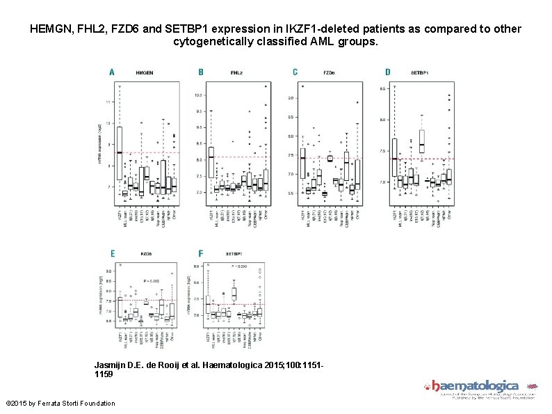 HEMGN, FHL 2, FZD 6 and SETBP 1 expression in IKZF 1 -deleted patients HEMGN, FHL 2, FZD 6 and SETBP 1 expression in IKZF 1 -deleted patients