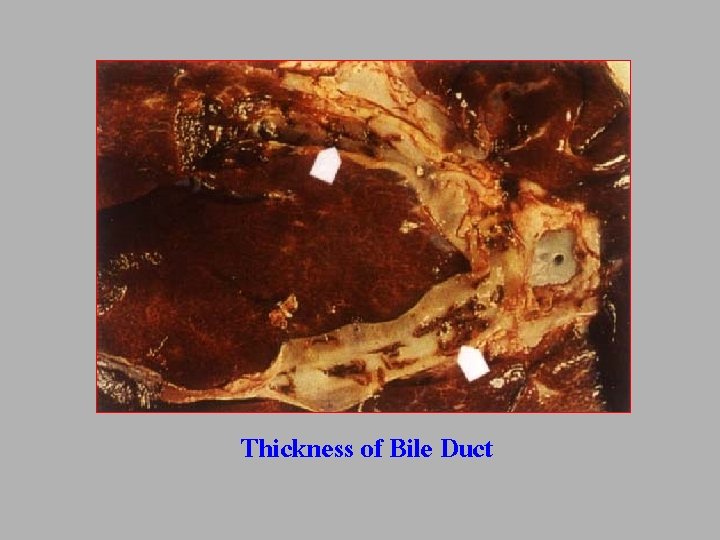 Thickness of Bile Duct 