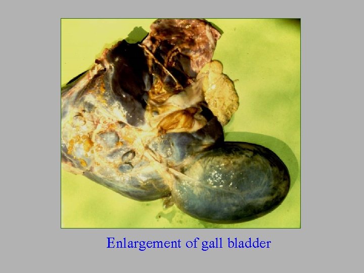 Enlargement of gall bladder 