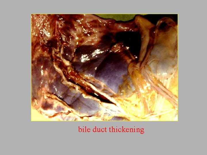 bile duct thickening 