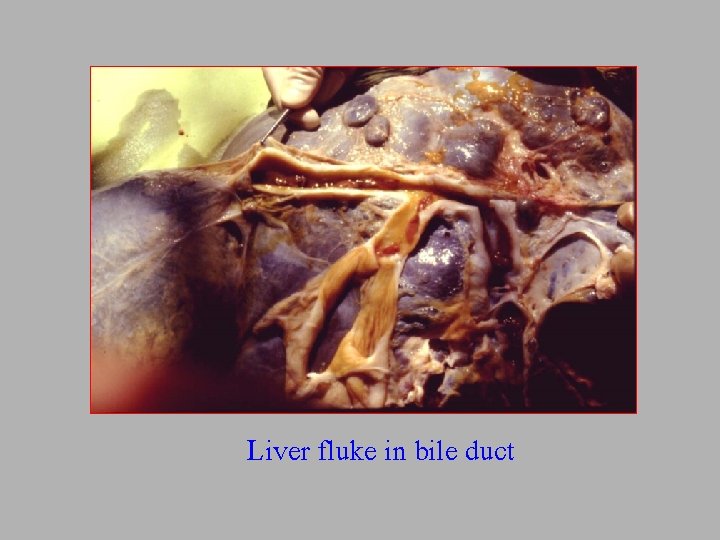 Liver fluke in bile duct 