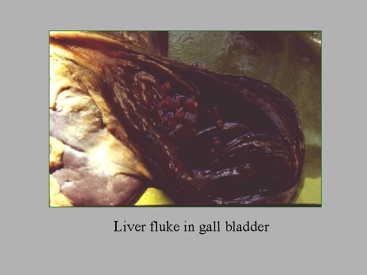 Liver fluke in gall bladder 