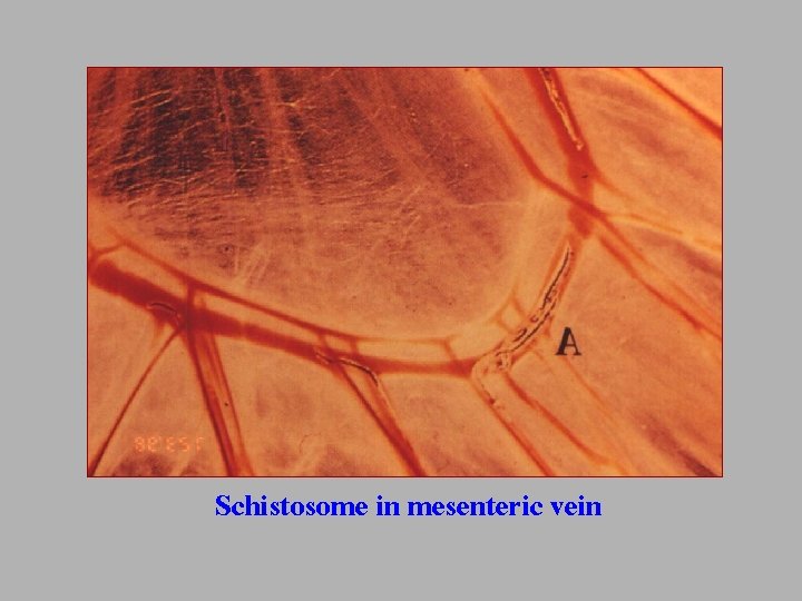 Schistosome in mesenteric vein 