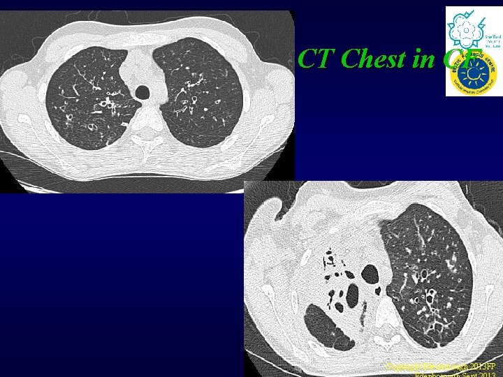 CT Chest in CF Copyright Edenborough 2013 FP CT Chest in CF Copyright Edenborough 2013 FP