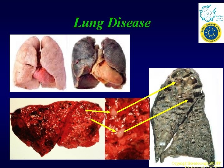 Lung Disease Copyright Edenborough 2013 FP Lung Disease Copyright Edenborough 2013 FP