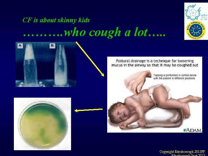 CF is about skinny kids ………. who cough a lot…. . Copyright Edenborough 2013 CF is about skinny kids ………. who cough a lot…. . Copyright Edenborough 2013