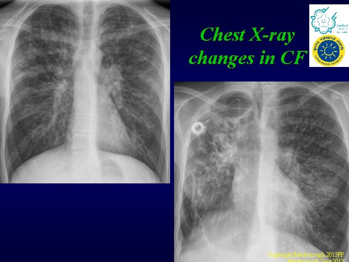 Chest X-ray changes in CF Copyright Edenborough 2013 FP Chest X-ray changes in CF Copyright Edenborough 2013 FP