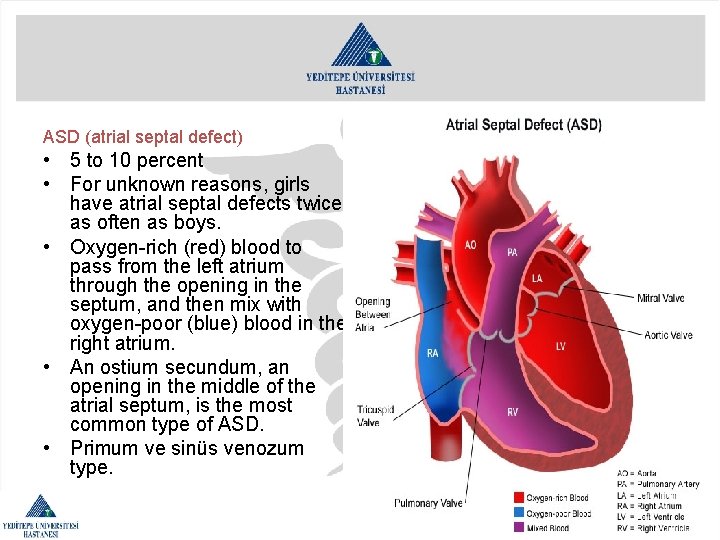 ASD (atrial septal defect) • 5 to 10 percent • For unknown reasons, girls